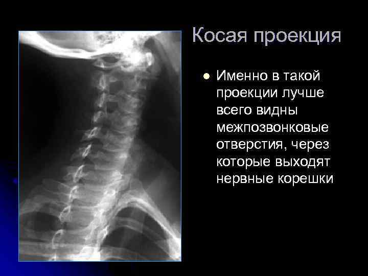 Косая проекция l Именно в такой проекции лучше всего видны межпозвонковые отверстия, через которые