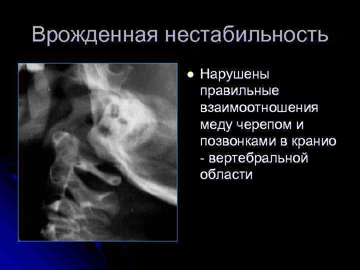 Врожденная нестабильность l Нарушены правильные взаимоотношения меду черепом и позвонками в кранио - вертебральной