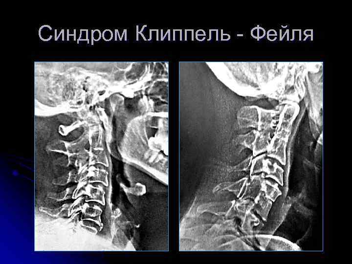 Синдром Клиппель - Фейля 
