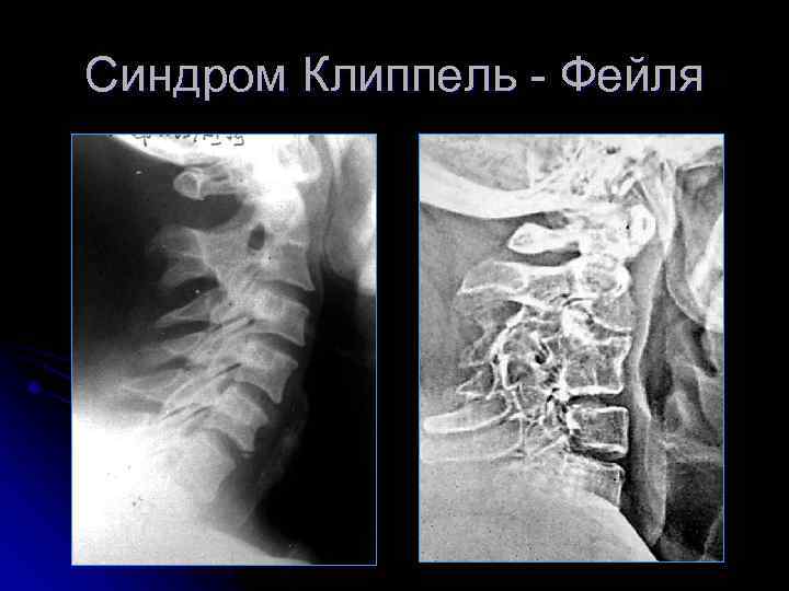 Синдром Клиппель - Фейля 