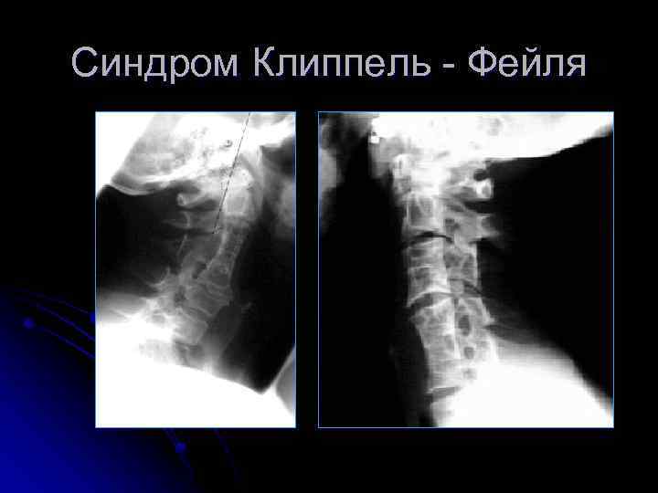 Синдром Клиппель - Фейля 
