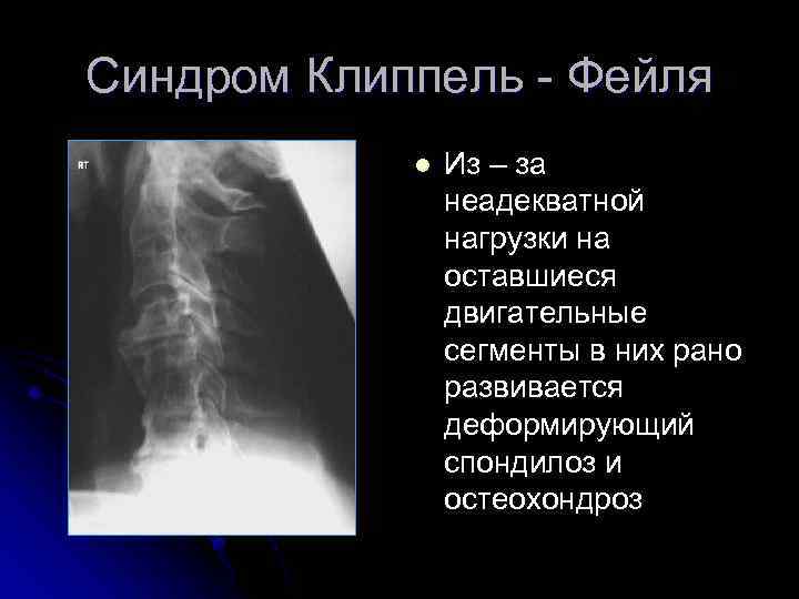 Синдром Клиппель - Фейля l Из – за неадекватной нагрузки на оставшиеся двигательные сегменты