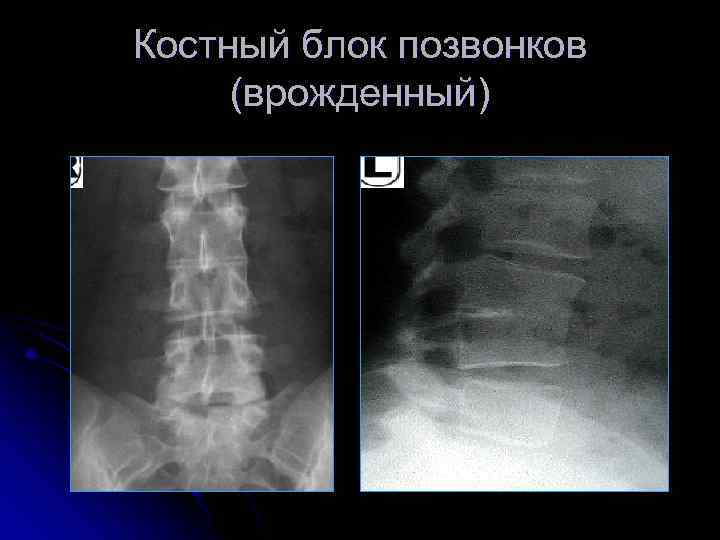 Костный блок позвонков (врожденный) 
