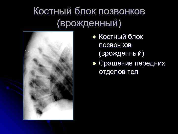 Костный блок позвонков (врожденный) l l Костный блок позвонков (врожденный) Сращение передних отделов тел