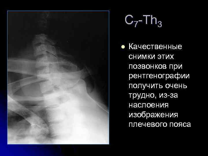 С 7 -Th 3 l Качественные снимки этих позвонков при рентгенографии получить очень трудно,