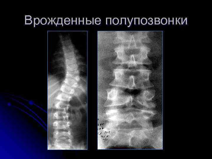Врожденные полупозвонки 