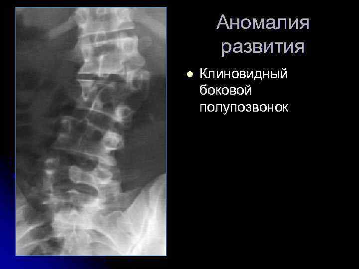 Аномалия развития l Клиновидный боковой полупозвонок 