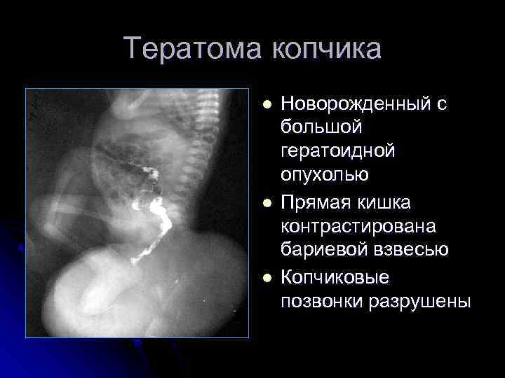 Тератома копчика l l l Новорожденный с большой гератоидной опухолью Прямая кишка контрастирована бариевой