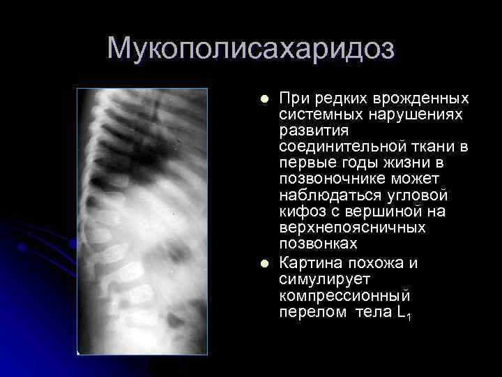 Мукополисахаридоз l l При редких врожденных системных нарушениях развития соединительной ткани в первые годы