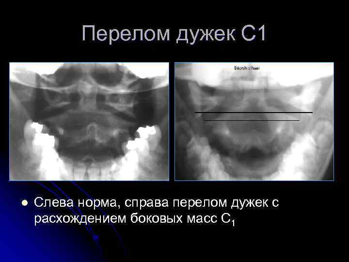 Перелом дужек С 1 l Слева норма, справа перелом дужек с расхождением боковых масс
