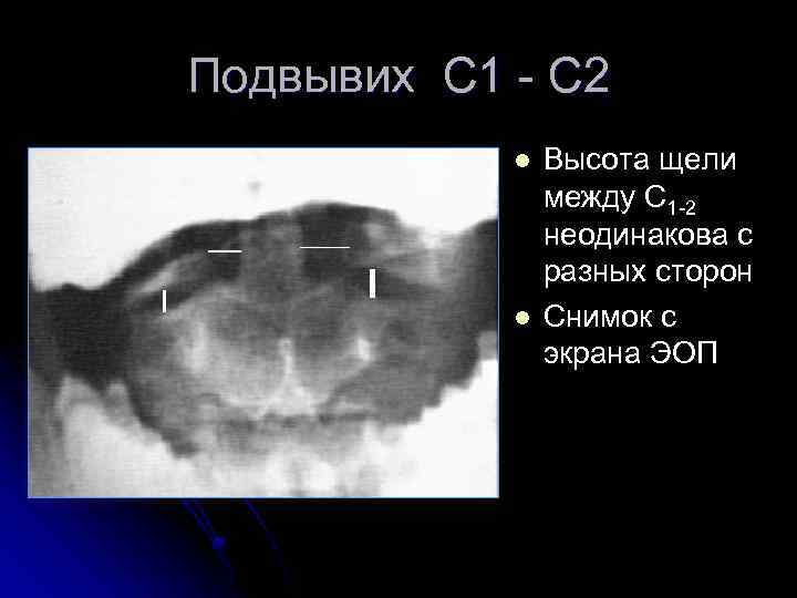 Подвывих С 1 - С 2 l l Высота щели между С 1 -2
