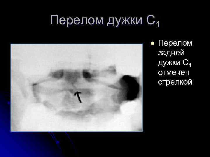 Перелом дужки С 1 l Перелом задней дужки С 1 отмечен стрелкой 