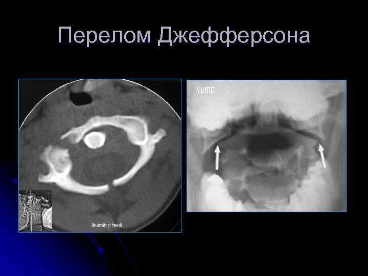 Перелом Джефферсона 