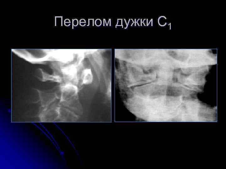 Перелом дужки С 1 