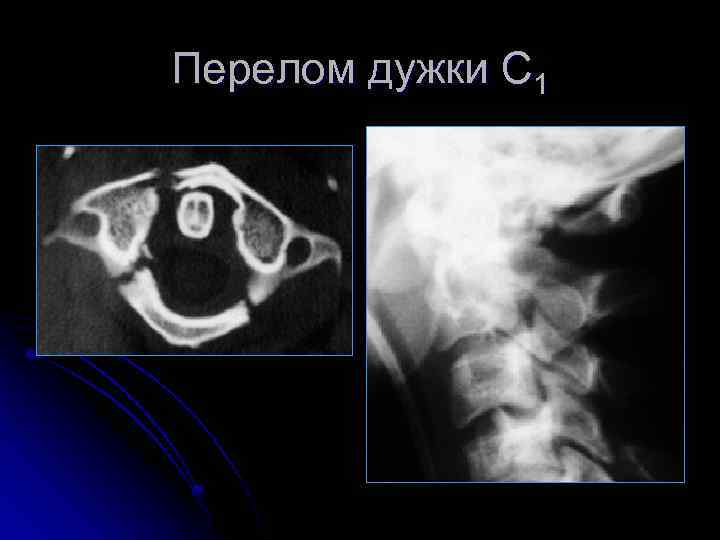 Перелом дужки С 1 