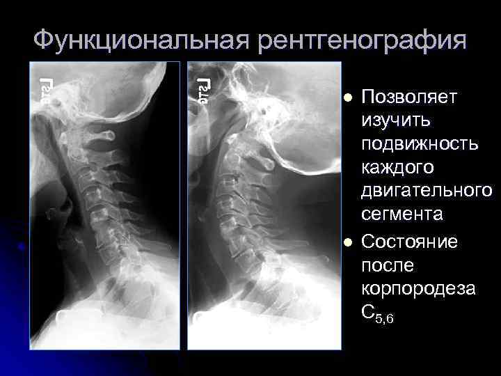 Функциональная рентгенография l l Позволяет изучить подвижность каждого двигательного сегмента Состояние после корпородеза C
