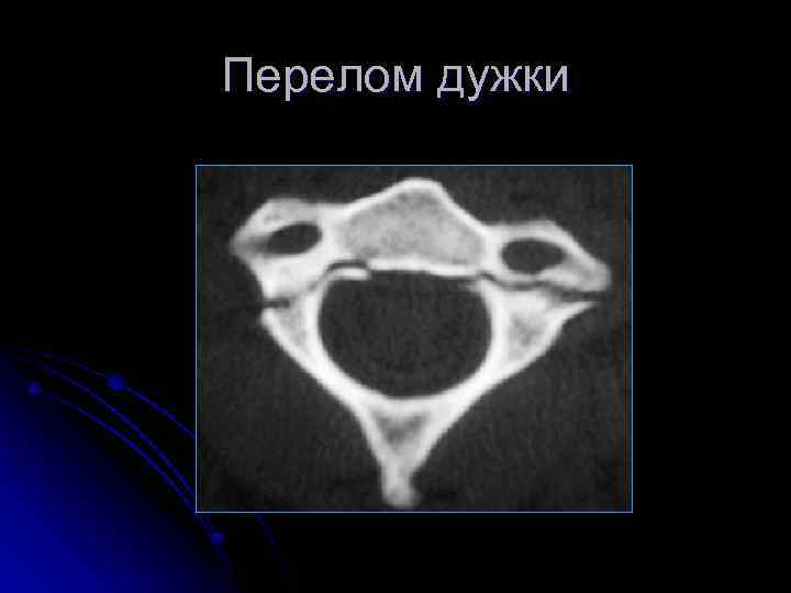 Перелом дужки 