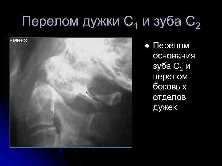 Перелом дужки С 1 и зуба С 2 l Перелом основания зуба С 2