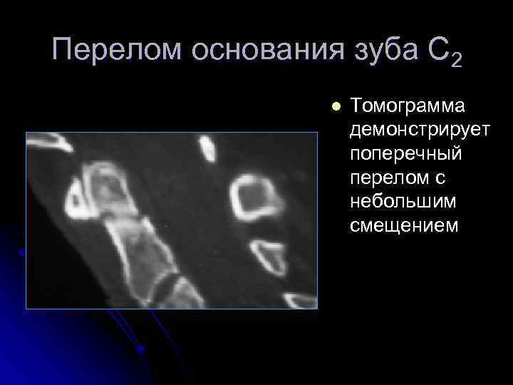 Перелом основания зуба С 2 l Томограмма демонстрирует поперечный перелом с небольшим смещением 