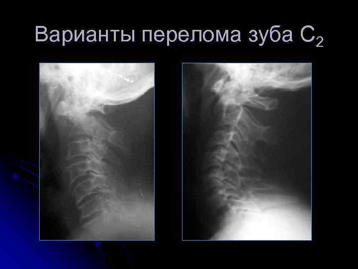 Варианты перелома зуба С 2 