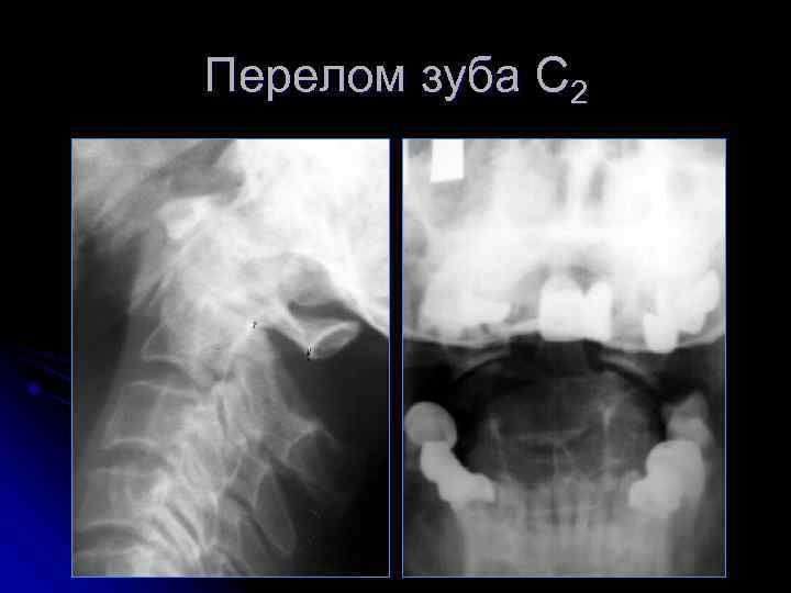 Перелом зуба С 2 