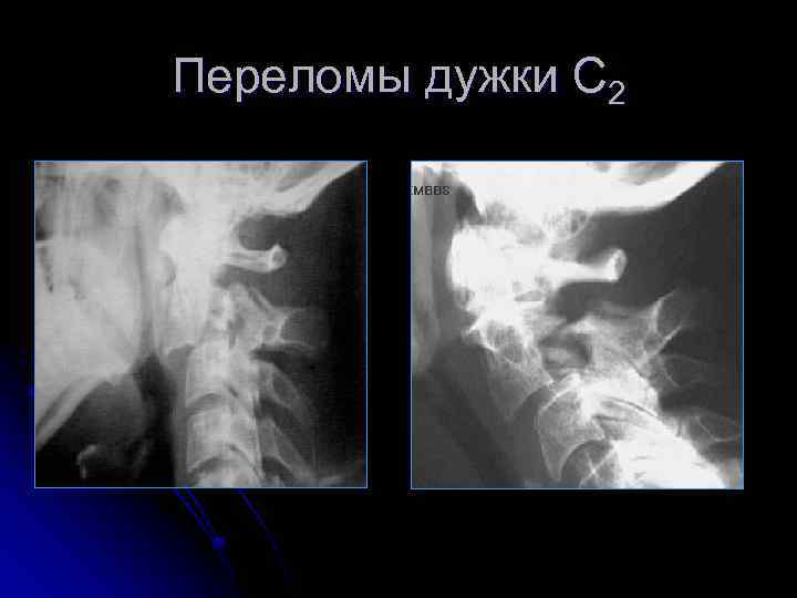 Переломы дужки С 2 