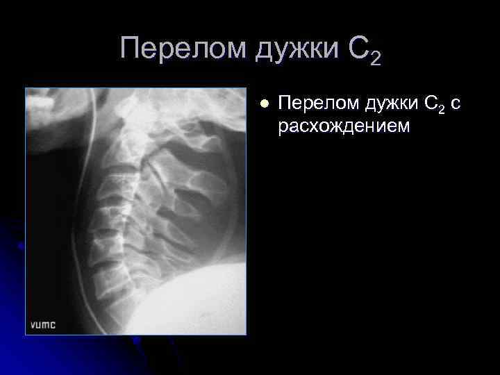 Перелом дужки С 2 l Перелом дужки С 2 с расхождением 