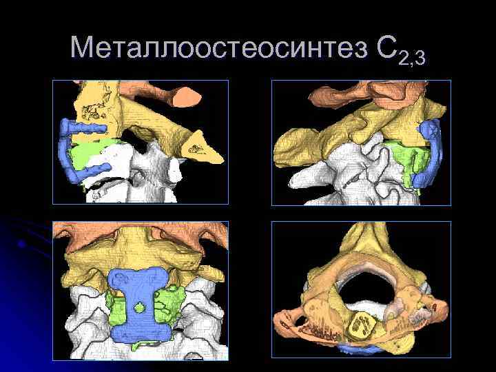 Металлоостеосинтез С 2, 3 