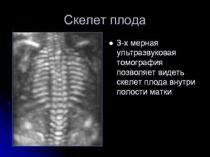 Скелет плода l 3 -х мерная ультразвуковая томография позволяет видеть скелет плода внутри полости