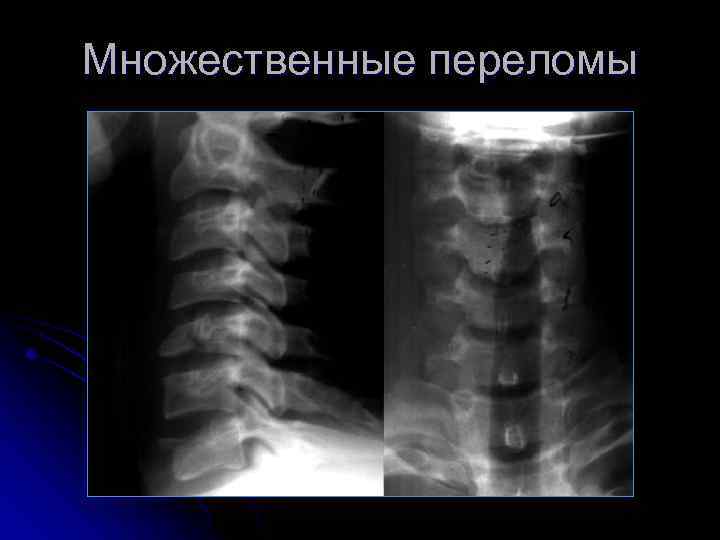 Множественные переломы 