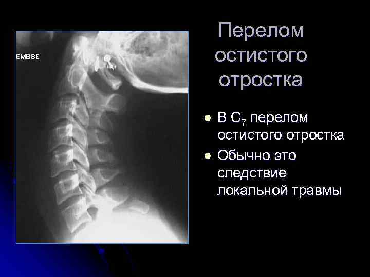 Перелом остистого отростка l l В С 7 перелом остистого отростка Обычно это следствие