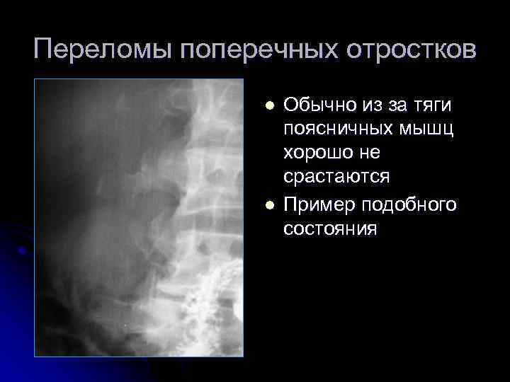 Переломы поперечных отростков l l Обычно из за тяги поясничных мышц хорошо не срастаются