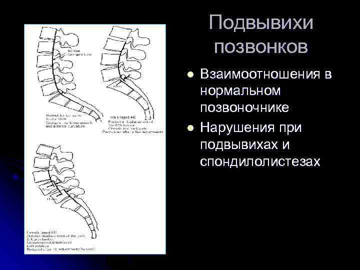 Подвывихи позвонков l l Взаимоотношения в нормальном позвоночнике Нарушения при подвывихах и спондилолистезах 
