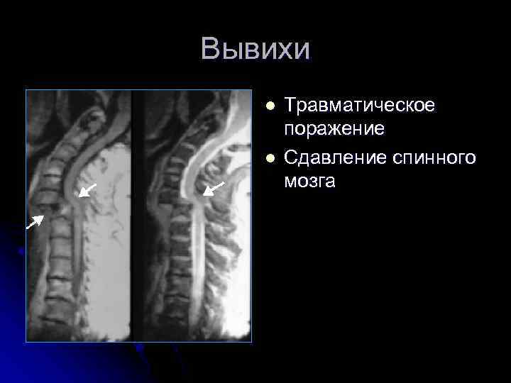 Вывихи l l Травматическое поражение Сдавление спинного мозга 