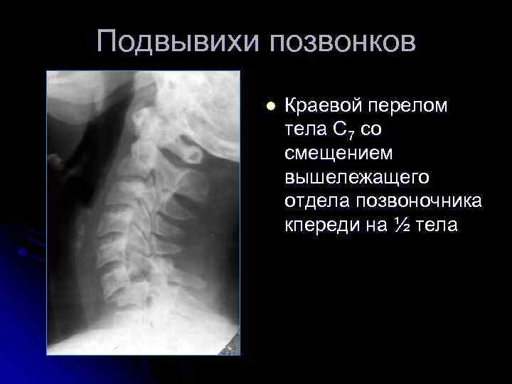 Подвывихи позвонков l Краевой перелом тела С 7 со смещением вышележащего отдела позвоночника кпереди