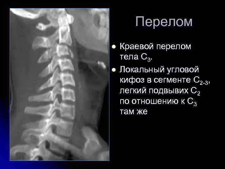 Перелом l l Краевой перелом тела С 3. Локальный угловой кифоз в сегменте С