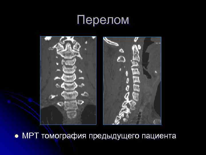 Перелом l МРТ томография предыдущего пациента 