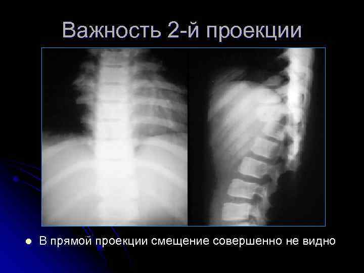 Важность 2 -й проекции l В прямой проекции смещение совершенно не видно 
