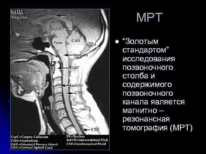 МРТ l “Золотым стандартом” исследования позвоночного столба и содержимого позвоночного канала является магнитно –