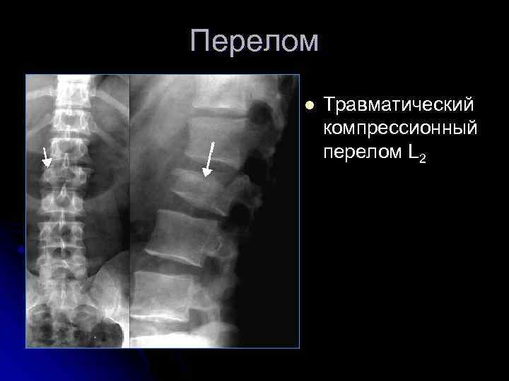 Перелом l Травматический компрессионный перелом L 2 
