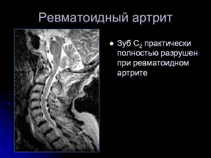 Ревматоидный артрит l Зуб С 2 практически полностью разрушен при ревматоидном артрите 
