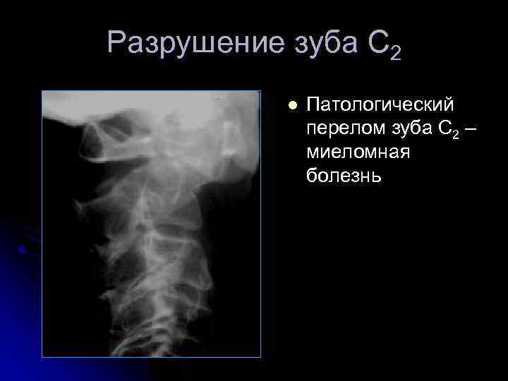 Разрушение зуба С 2 l Патологический перелом зуба С 2 – миеломная болезнь 