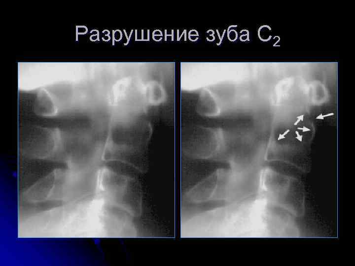 Разрушение зуба С 2 