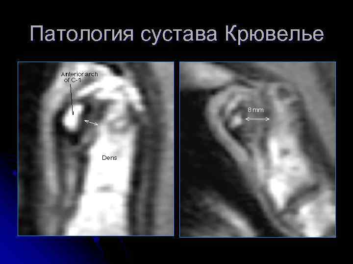 Патология сустава Крювелье 