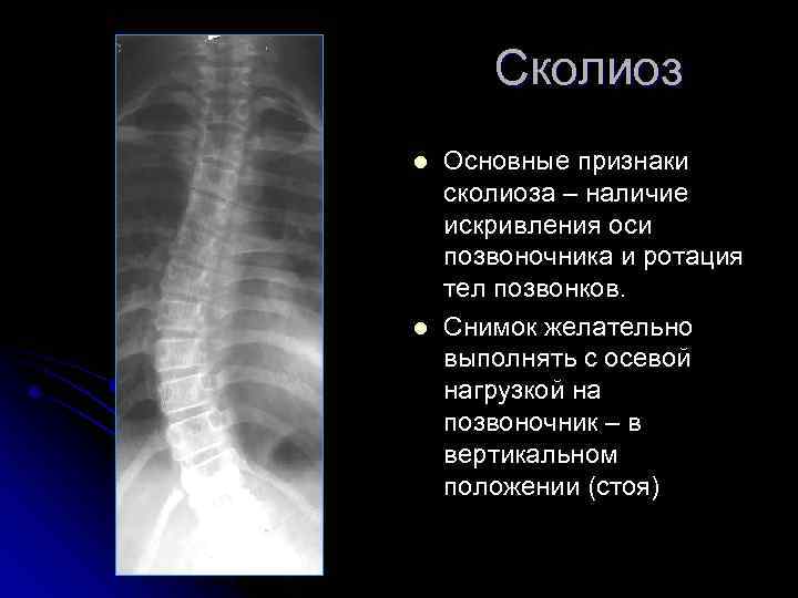 Сколиоз l l Основные признаки сколиоза – наличие искривления оси позвоночника и ротация тел