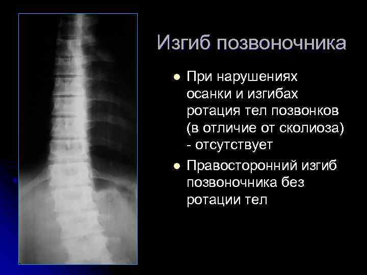 Изгиб позвоночника l l При нарушениях осанки и изгибах ротация тел позвонков (в отличие
