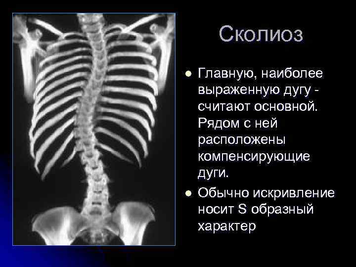 Сколиоз l l Главную, наиболее выраженную дугу считают основной. Рядом с ней расположены компенсирующие