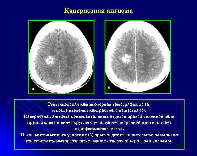 Кавернозная ангиома а б Рентгеновская компьютерная томография до (а) и после введения контрастного вещества