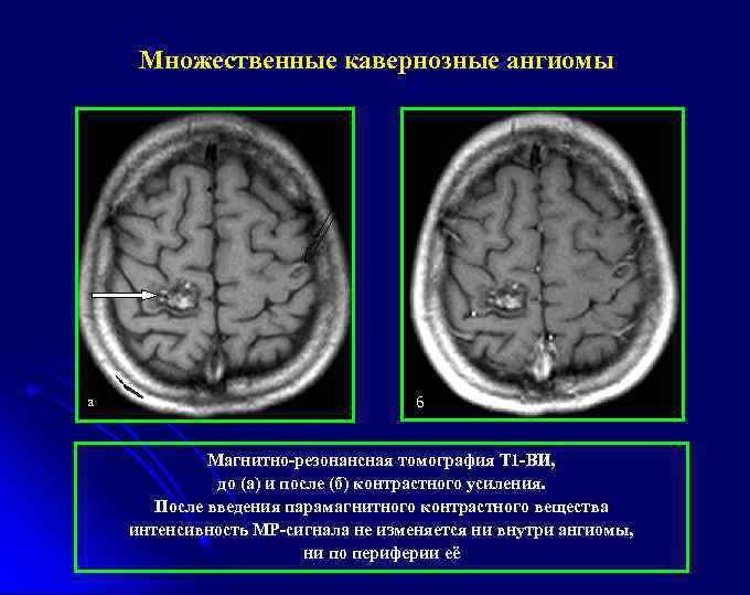 Множественные кавернозные ангиомы а б Магнитно-резонансная томография Т 1 -ВИ, до (а) и после