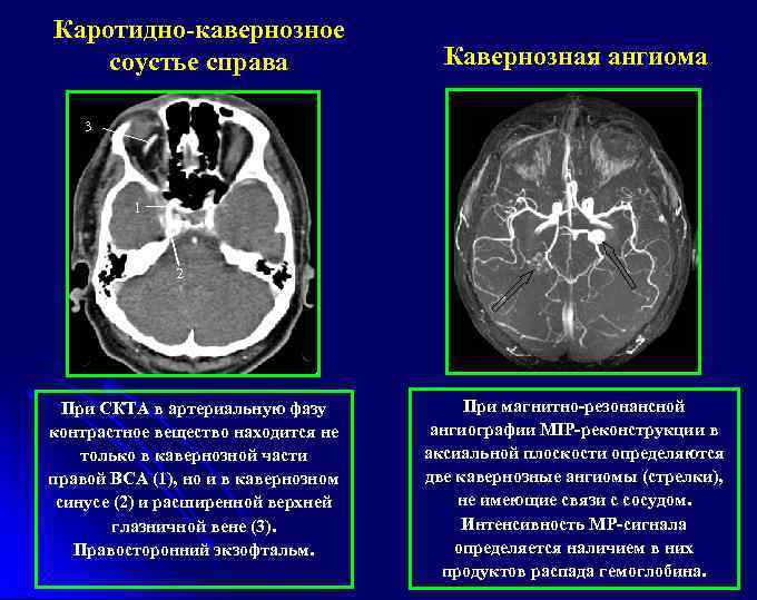 Каротидно-кавернозное соустье справа Кавернозная ангиома 3 1 2 При СКТА в артериальную фазу контрастное